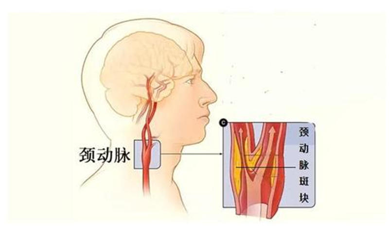 颈动脉斑块、心律不齐 这些体检异常不必惊